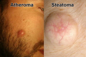 Atheroma steatoma