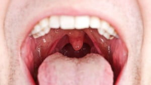 Mouth Tumors