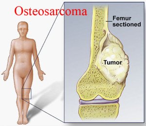 Osteosarcoma