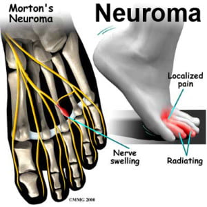 neuroma