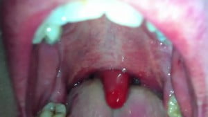 Uvula Inflammation