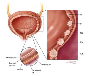 anatomy_bladdercancer