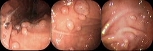 benign_gastric_tumors