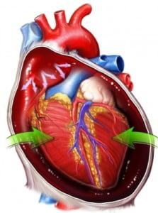 cardiac-tumors