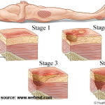 Bedsores decubitus 2