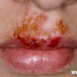 impetigo 1