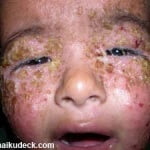 impetigo 2