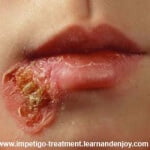 impetigo 3