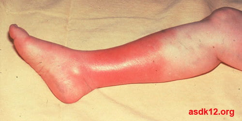 কোষপ্রদাহের (Cellulitis) চিকিৎসা।