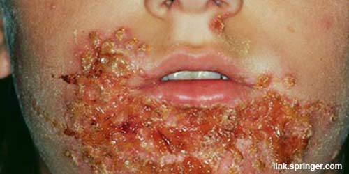 ইমপেটিগোর (Impetigo) চিকিৎসা