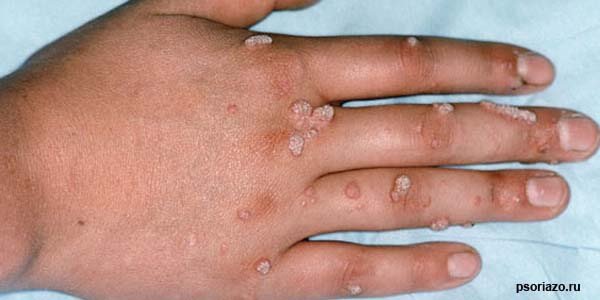 আঁচিলের হোমিওপ্যাথিক চিকিৎসা (Warts)